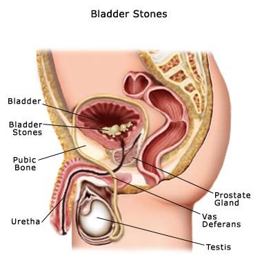 Bladder stone symptoms photo Bladderstones9.jpg