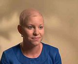 alopecia
