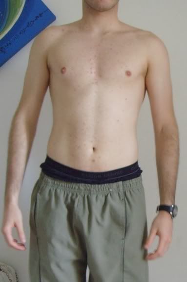 Hipertrofia1MsAtrs1.jpg